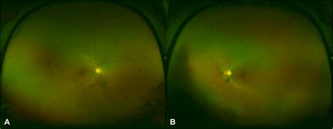 Ultra Widefield Color Fundus Photos Of The Right A And Left B Eye