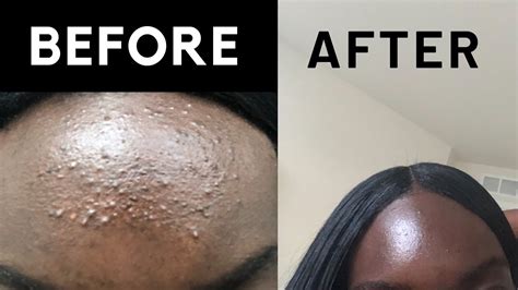 How I Cleared My Tiny Forehead Bumps Fast My Skin Care Routine Youtube