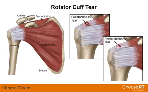 Guide Physical Therapy Guide For Rotator Cuff Tears