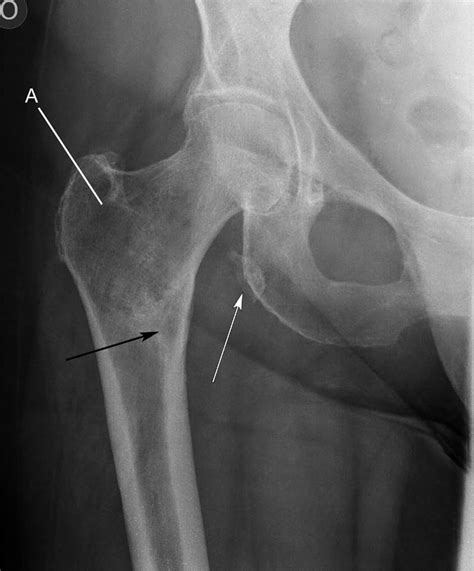 Hip Pain In A Middle Aged Woman The Bmj