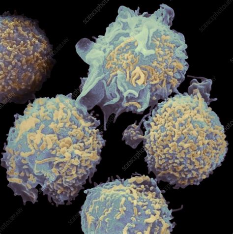 Lymphocytes In Hairy Cell Leukaemia Stock Image M1320551 Science