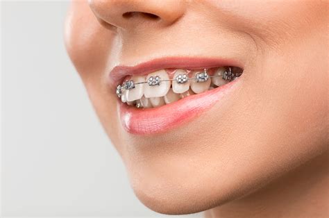 How Do Braces Work? - Lampros & Reopelle Orthodontics
