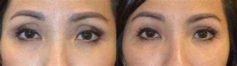 Before After Eyelid Filler Dr Mehryar Ray Taban Md Oculoplastic