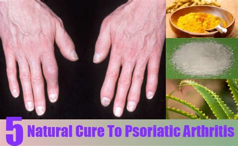 Natural Cure To Psoriatic Arthritis Dorothee Padraig South West Skin