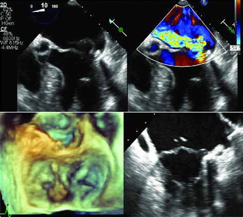 Transesophageal Echo View Of A Prolapse With Flail Of The Posterior