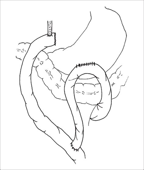 —combined Gastric And Biliary Bypass For The Treatment Of Obstructive