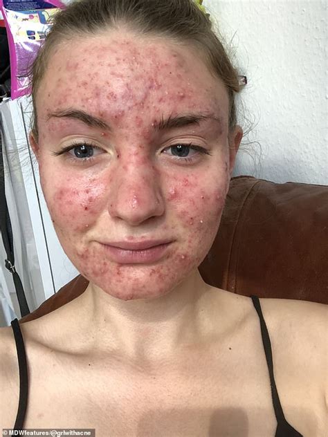 Woman Who Had Cystic Acne So Severe That It Affected Her Sight ReadSector