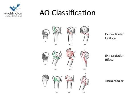 Ao Classification Humerus Fracture