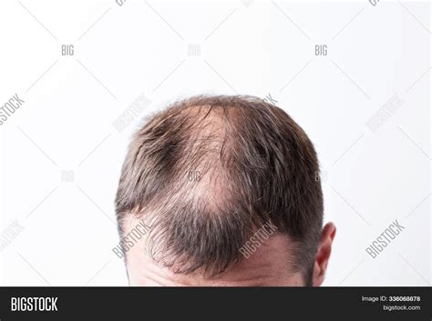 Close Balding Head Image And Photo Free Trial Bigstock