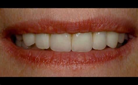 Full Mouth Rehabilitation California Smile Dental Studio