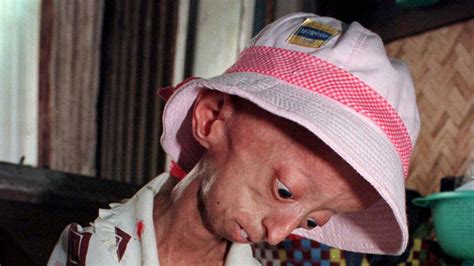 Study Of Rare Disease Progeria Helps In Search For Clues On Aging Fox