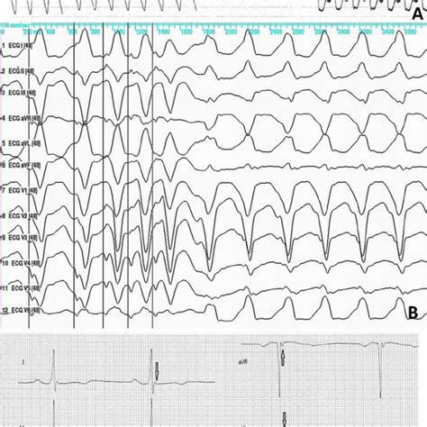 A The Clinical Ventricular Tachycardia Vt Note That The Morphology