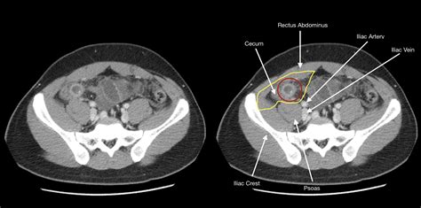How To Find The Appendix On Imaging Stepwards