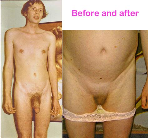 Before And After Nude Transexual - Post Op Tranny Before And After Nude Photos | Free Hot Nude Porn Pic Gallery