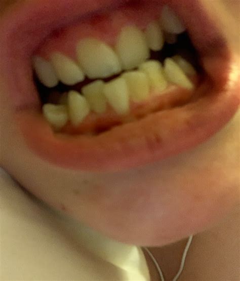 46 how to get rid of gaps in my teeth. Will I have gaps in my teeth?