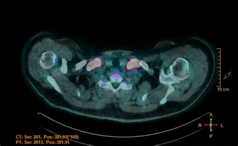 Pet Ct Image Showing Pathological Uptake In The Supraclavicular Lymph