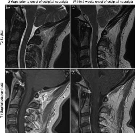 Occipital Neuralgia Associates With High Cervical Spinal Cord Lesions