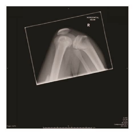 Plain Radiographs Of Left A And Right B Proximal Tibial Avulsion