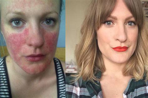 My Rosacea Story My Diagnosis And Photos Talonted Lex