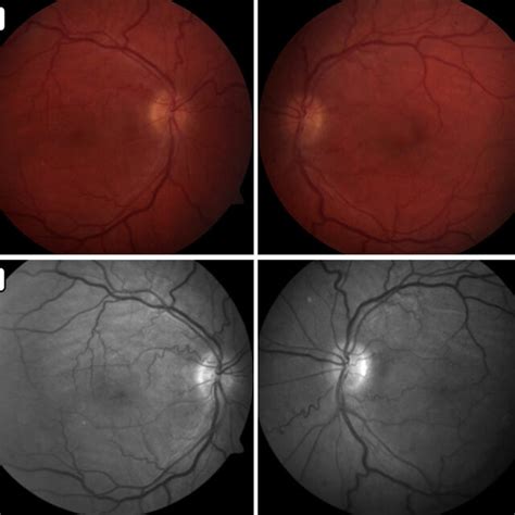 Fundus Photographs A And Red Free Photographs B Showing