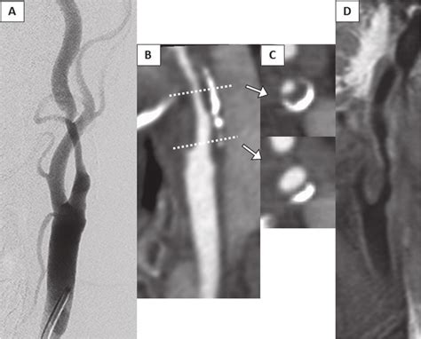 A A Carotid Artery Angiogram AP View Shows Stenosis NASCET 70 Of