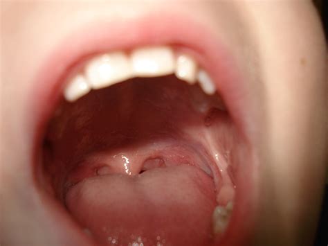 How To Get Rid Of A Canker Sore In Your Mouth Naturally