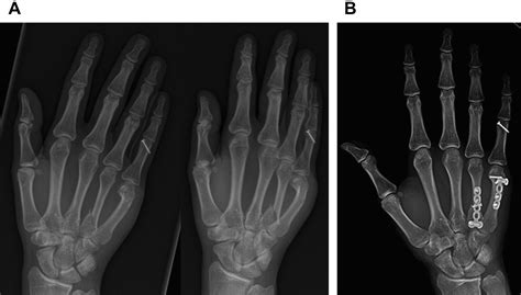 Current Management Of Metacarpal Fractures Hand Clinics
