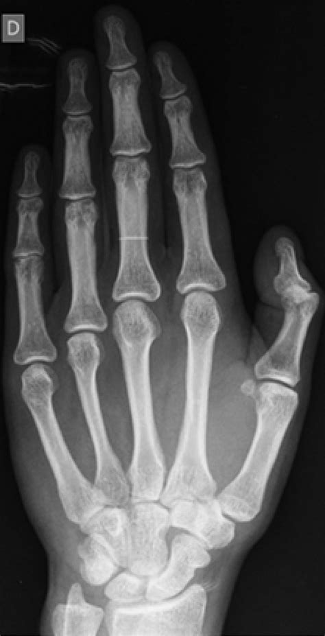 Right Hand Anteroposterior Radiograph Of The Normal Patient Download