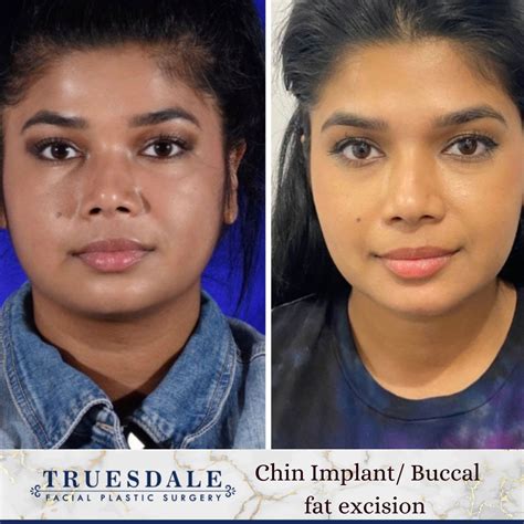 Buccal Fat Removal Gallery