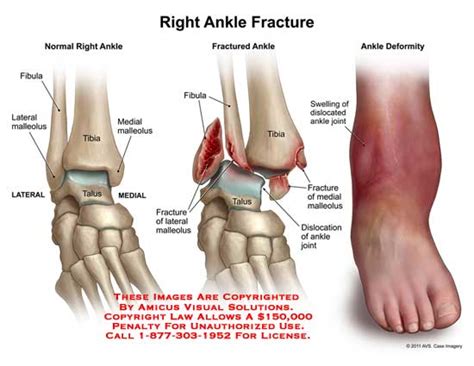 AMICUS Illustration Of Amicus Ankle Fracture Fibula Malleolus Tibia