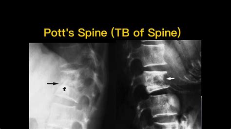 Potts Spine And Tb Of Hip Youtube
