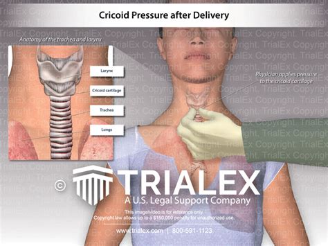 Cricoid Pressure After Delivery Trialexhibits Inc