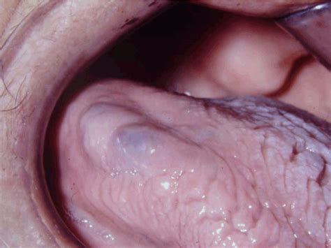 Full Text Dabska Tumor Of The Tongue A Clinicopathological Study
