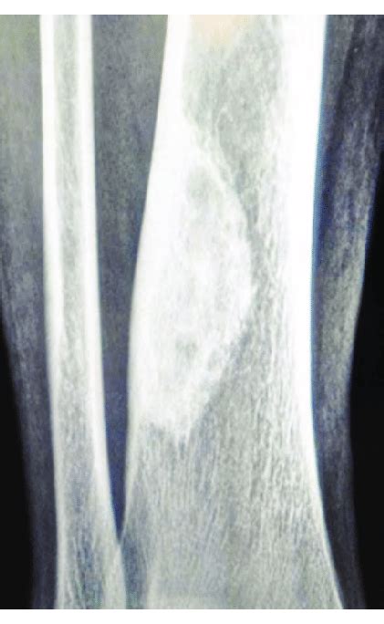 C Healing Non Ossifying Fibroma Lower End Of Tibia Download