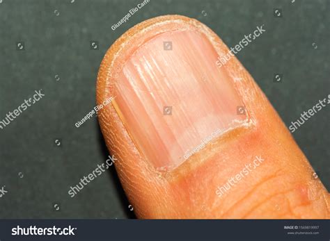 Vertical Ridges On Fingernails Symptoms Deficiency Stock Photo