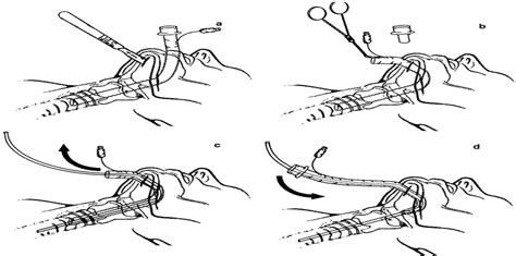 Facilitating Submental Endotracheal Intubation With An Endot