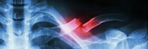 Three Stages Of The Broken Collarbone Treatment For Mountain Bikers
