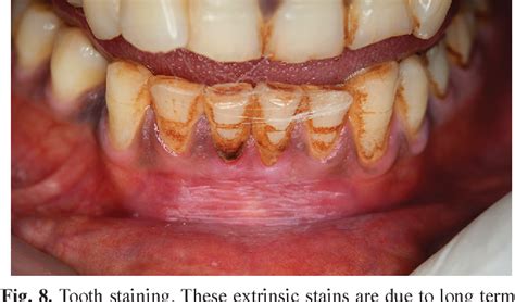 Figure 1 From Oral Health Consequences Of Smokeless Tobacco Use