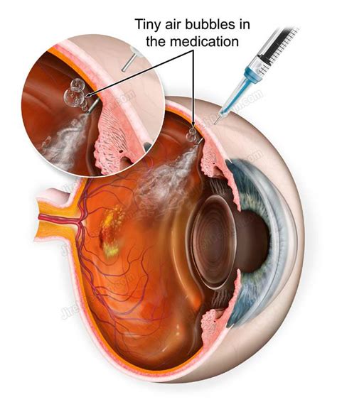 Retinal Injection To Treat Detachment Easy Health Care Solution