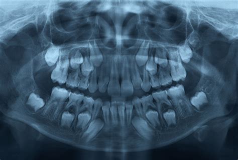 Pediatric Dental X Rays Radiography Lonestar Kids Dentistry