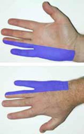 Ulnar Nerve Entrapment At The Elbow Cubital Tunnel Syndrome