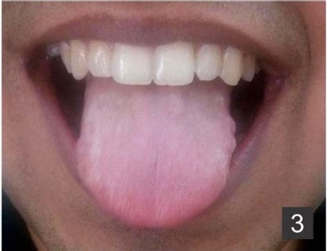 Complete Resolution Of Black Hairy Tongue After Withdrawal Of Drug