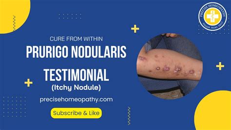Skin Allergy Prurigo Nodularis Complete Cure With Precise Treatment