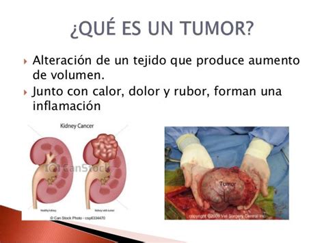 Información Sobre Tumores