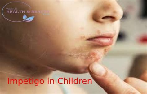 Impetigo In Children Causes Symptoms Diagnosis And Treatment