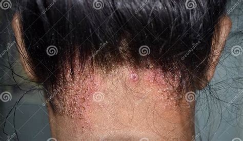 Dermatite Séborrhéique Ou Infection Fongique De La Peau Au Cuir Chevelu