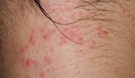 7 Types Of Eczema