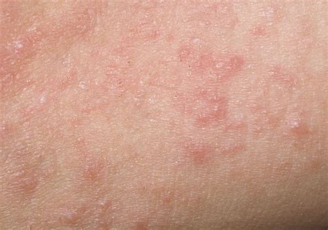 What Does Dermatitis Look Like Symptoms And Pictures