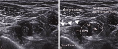 Ultrasound Image Of The Perineural And Subparaneural Spaces Shown Are