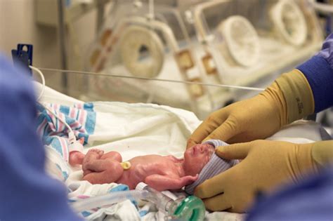 Neonatal Intensive Care Preemie Babies Premature Baby Preemies